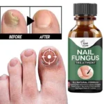 Fast Nail Fungal Treatments Nail Repair Essences Serum Care Treatments – Foot Nail Fungus Removal Gel for Paronychia & Onychomycosis - Image 4